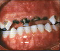 toothdecay3